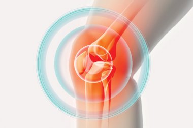 Terapia con células madre: una alternativa para la osteoartritis de rodilla